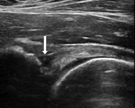 acetabular labral tear ultrasound